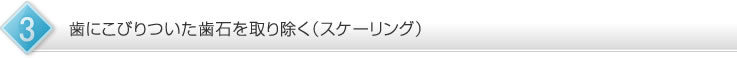 歯にこびりついた歯石を取り除く（スケーリング）