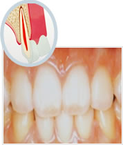 歯周病の進行イメージ1