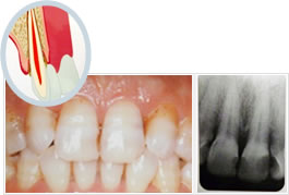 歯周病の進行イメージ3