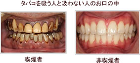 タバコを吸う人と吸わない人のお口の中